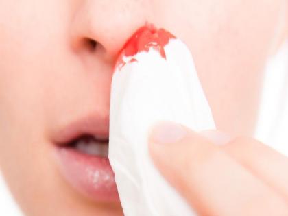 How do you stop a nose bleed in summer | उन्हाळ्यात नाकातून रक्त का येते? काय करायचे उपाय?