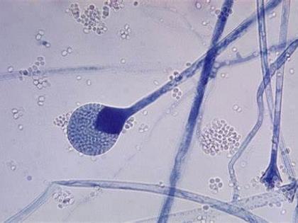 Patients with mucorrhoea are living with a squint face; When will the funds be available? | विद्रुप चेहरा घेऊन जगत आहेत म्युकरमायकोसिसचे रुग्ण; निधी केव्हा मिळणार?