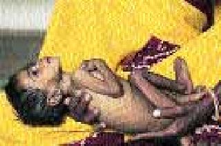 Malnutrition kamajali future generation! | कुपोषणाने कोमेजली भावी पिढी ! Malnutrition kamajali future generation! | कुपोषणाने कोमेजली भावी पिढी !