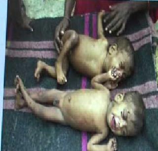 Malnutrition emanating from privatization | खासगीकरणातून कुपोषणमुक्ती Malnutrition emanating from privatization | खासगीकरणातून कुपोषणमुक्ती