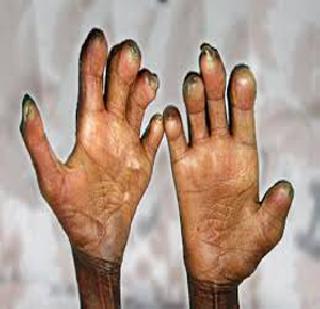 Leprosy crippled anecdotes | कुष्ठरुग्णांचे अपंगत्व ऐरणीवर Leprosy crippled anecdotes | कुष्ठरुग्णांचे अपंगत्व ऐरणीवर