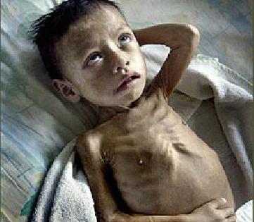 Andheri, Juhu, 125 malnourished children | अंधेरी, जुहूत १२५ कुपोषित बालके