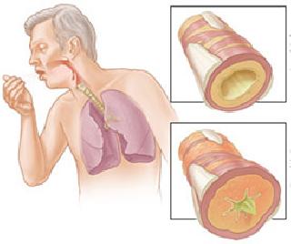 COPD Disease Disease | चाळिशीनंतर वाढतोय ‘सीओपीडी’ आजाराचा धोका COPD Disease Disease | चाळिशीनंतर वाढतोय ‘सीओपीडी’ आजाराचा धोका