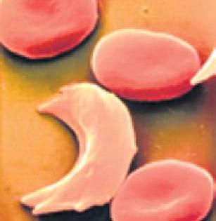 Special blood supply to patients with sickle-thalassemia | सिकलसेल-थॅलेसेमियाच्या रुग्णांना विशेष रक्तपुरवठा Special blood supply to patients with sickle-thalassemia | सिकलसेल-थॅलेसेमियाच्या रुग्णांना विशेष रक्तपुरवठा