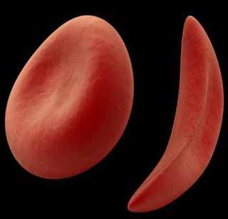 110 cases of sickle cell in Washim district | वाशिम जिल्ह्यात सिकलसेलचे ११0 रुग्ण