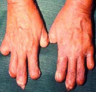 126 new cases of leprosy | कुष्ठरोगाचे १२६ नवे रुग्ण