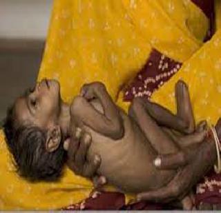 Thane, Palghar: 10645 malnourished children | ठाणे,पालघर : १०६४५ बालके कुपोषित