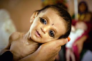 73 child deaths due to malnutrition | कुपोषणाने ७३ बालकांचा मृत्यू 73 child deaths due to malnutrition | कुपोषणाने ७३ बालकांचा मृत्यू