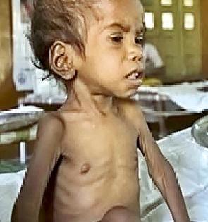 518 children report malnutrition | ५१८ बालके कुपोषणाच्या विळख्यात 518 children report malnutrition | ५१८ बालके कुपोषणाच्या विळख्यात