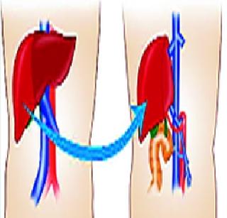 In the rare operation, the two parts became new liver | दुर्मिळ शस्त्रक्रियेत दोन भाग जोडत बनले नवे यकृत