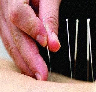 Recognition of acupuncturist therapy | अ‍ॅक्युपंक्चर चिकित्सा पद्धतीला मान्यता