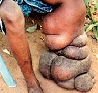 1783 cases of elephants in the district | जिल्ह्यात हत्तीपायाचे १७८३ रुग्ण 1783 cases of elephants in the district | जिल्ह्यात हत्तीपायाचे १७८३ रुग्ण