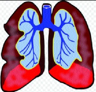 Drugs sensitivity test for tuberculosis | क्षयरुग्णांसाठी ‘ड्रग्ज सेन्सेटिव्हिटी टेस्ट’