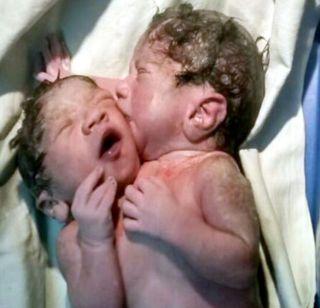 Siamese twins born in Sion hospital | सायन रुग्णालयात जन्मले सयामी जुळे