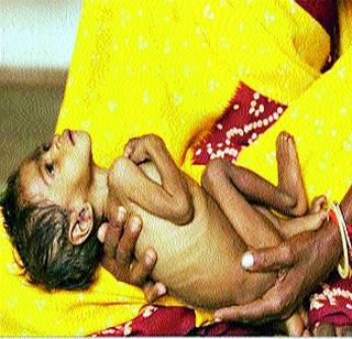 Challenge of malnutrition against Zilla Parishad | जिल्हा परिषदेपुढे कुपोषणमुक्तीचे आव्हान