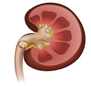 During pneumonia surgery, kidneys have disappeared | मुतखड्याच्या शस्त्रक्रियेदरम्यान किडनीच केली गायब