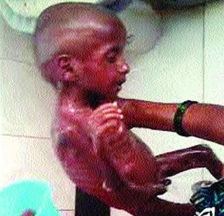 Death of 16 children in malnourished in five months in Dacca | तलासरीत ५ महिन्यांत कुपोषित १६ बालकांचा मृत्यू Death of 16 children in malnourished in five months in Dacca | तलासरीत ५ महिन्यांत कुपोषित १६ बालकांचा मृत्यू