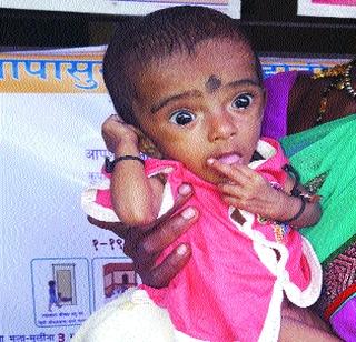 Health Minister visits Mumbai after not seeing malnourished girl | कुपोषित मुलीला न बघताच आरोग्यमंत्र्यांनी गाठली मुंबई