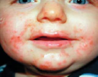 Be careful! 'Hand, Foot, Mouth Disease' is phofering | सावधान !‘हँड, फुट, माऊथ डिसीज’फोफावतोय