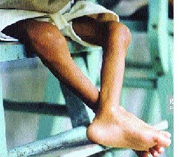 4 thousand 578 children in the district are on the verge of malnutrition | जिल्ह्यातील ४ हजार ५७८ बालके कुपोषणाच्या उंबरठ्यावर