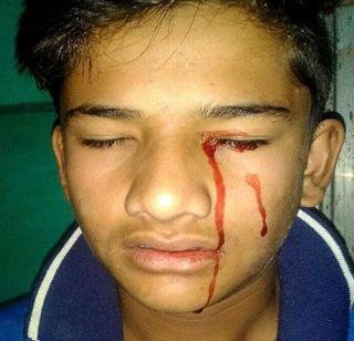 Blood of the 13-year-old boy, like the prophylactually shingles! | 13 वर्षीय मुलाच्या डोळ्यातून वाहते आसवांप्रमाणे रक्ताची धार !