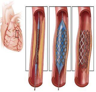 Heart patients relief! Government cuts stent price cut | हृदय रुग्णांना दिलासा! सरकारने स्टेंटच्या किमतीत केली मोठी कपात