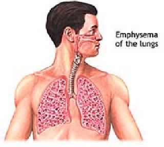 Patients with lung cancer are growing | फुफ्फुसाच्या कॅन्सरचे रुग्ण वाढताहेत