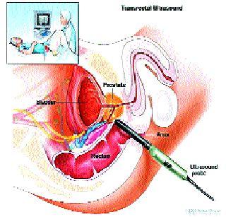 Learn, prostate cancer | जाणून घ्या, प्रोस्टेट कॅन्सर