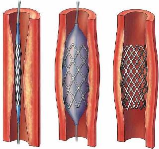 Seven years of imprisonment for selling stents at an increasing rate | अवाजवी दरात स्टेंट विकणाऱ्यांना सात वर्षांच्या कारावासाची शिक्षा