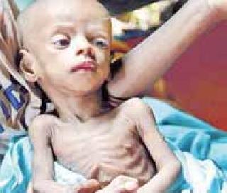 18.57 percent child malnutrition | १८.५७ टक्के बालकांवर कुपोषणाची छाया