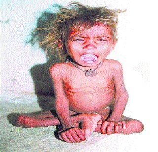 The malnourished children are four times the size | कुपोषित मुलांचे प्रमाण चौपट