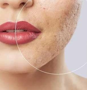 टिश्यू डॅमेज झाल्याने चेहऱ्यावर खड्डे-डाग ठळक दिसू लागलेत? एकदा ट्राय करा 'हे' उपाय, दिसेल फरक