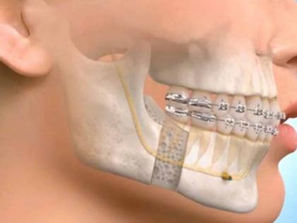 World Oral Surgery Day; 250 squiggly faces changed 'look' | जागतिक मुख शल्य चिकित्सा दिन; २५० विद्रूप चेहऱ्यांचा बदलला ‘लूक’ World Oral Surgery Day; 250 squiggly faces changed 'look' | जागतिक मुख शल्य चिकित्सा दिन; २५० विद्रूप चेहऱ्यांचा बदलला ‘लूक’