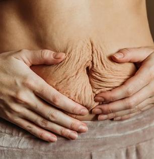 बाळंतपणानंतर वाढलेले पोट कसे कमी कराल? ४ उपाय- पोटाचा वाढलेला घेर होईल कमी