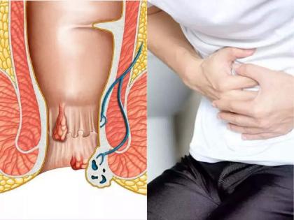 Causes of piles and its control home remedies | पाइल्समुळे जगणं अवघड झालंय? लगेच या 4 गोष्टी टाळा, होईल फायदा