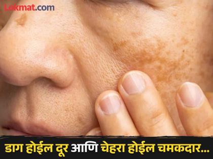 Home remedies to get rid of pigmentation from face | महागड्या प्रोडक्ट्सची गरज नाही, 'या' घरगुती उपायांनी लगेच दूर होतील चेहऱ्यावरील डाग