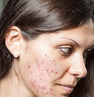 चेहऱ्यावरील पुरळ, डाग गायब करण्याचा रामबाण उपाय, ७ दिवसात चेहरा होईल चमकदार...