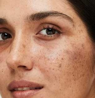 पिंपल्सच्या काळ्या डागांमुळे चेहरा खराब दिसतो? तुळशीच्या पानांचा सोपा उपाय- चेहरा होईल स्वच्छ, नितळ