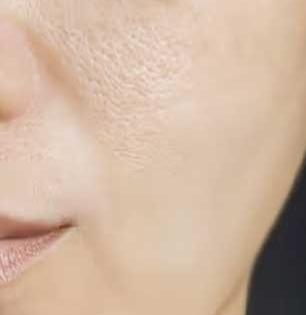 पिग्मेंटेशन, डोळ्याभोवती काळी वर्तुळे- चेहरा टॅन? बटाट्याच्या रसात मिसळा ३ पदार्थ, चेहऱ्यावरचे वांग-काळे डाग होतील कमी