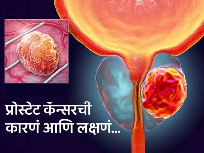 Prostate Cancer: Prostate cancer cases will rise to double in next 20 years claims lancet study | २० वर्षांमध्ये दुप्पट होतील प्रोस्टेट कॅन्सरचे रूग्ण? पुरूषांसाठी चिंताजनक रिपोर्ट, जाणून घ्या लक्षणं...