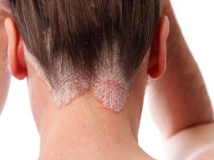 Psoriasis problem increases in winter 7 tips will keep you safe | थंडीमध्ये वाढते सोरायसिसची समस्या; दुर्लक्ष करणं पडू शकतं महागात