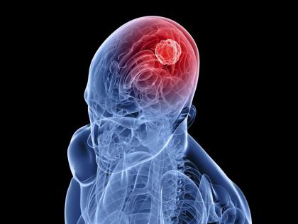 World Brain Tumor Day; 16% more likely in women than men | जागतिक ब्रेन ट्यमूर दिन; पुरुषांपेक्षा महिलांमध्ये १६ टक्क्यांनी अधिक शक्यता World Brain Tumor Day; 16% more likely in women than men | जागतिक ब्रेन ट्यमूर दिन; पुरुषांपेक्षा महिलांमध्ये १६ टक्क्यांनी अधिक शक्यता