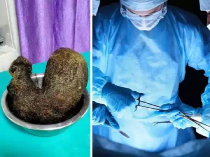 1-kg-hair-removed-from-13-year-old-girl-this-syndrome-is-known-as-rapunzel-syndrome | धक्कादायक! मुलीच्या पोटातुन काढला १ किलो केसांचा गोळा..असा कोणता आजार ?