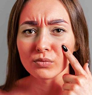 उन्हाळ्यात घामामुळे त्वचा लाल-रॅशेस- पुरळ येतात, सतत खाज सुटते? ५ घरगुती उपाय, त्रास होईल कमी