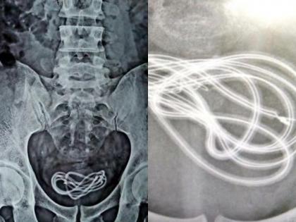 OMG! Assam man complained of stomach ache had charger cable in his bladder | बाबो! पोटात दुखत होतं म्हणून दवाखान्यात गेला, डॉक्टरांनी एक्स-रे पाहिला तर मूत्राशयात होता चार्जरचा केबल!