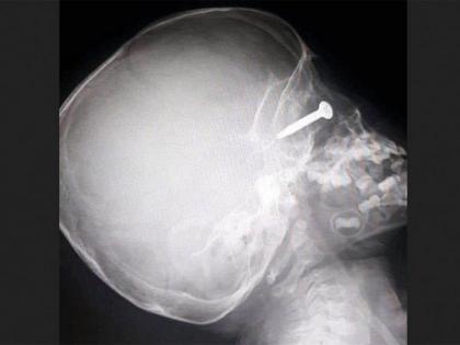 Kid almost blinded after dads lawnmower fires screw into his eyeball | लॉनमधील गवत कापत होते वडील, अचानक एक खिळा उडून मुलाच्या डोळ्यात घुसला अन्