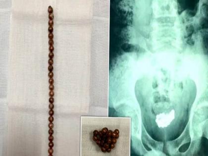 बोंबला! मजेसाठी 'त्याने' प्रायव्हेट पार्टमध्ये टाकले असे काही, सीटी स्कॅन पाहून डॉक्टरही झाले हैराण.....