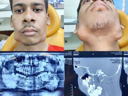 Patna doctors removed 82 teeth from the jaw of a 17 year old boy, it was because of the tumor | १७ वर्षीय तरूणाच्या जबड्यातून डॉक्टरांनी काढले ८२ दात, ट्यूमरमुळे तयार झाला होता दातांचा गोळा