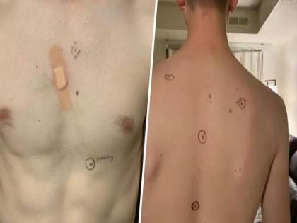 A woman sent her husband to the doctor after circling around concerning moles on his body | पतीच्या शरीरावरील तिळांना पेनाने सर्कल करून पाठवलं दवाखान्यात, घरी येऊन शर्ट काढलं तर...