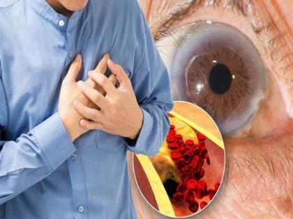 High Cholesterol : 3 symptoms found on the hands skin and eyes high cholesterol | High Cholesterol : कोलेस्ट्रॉल वाढलं तर शरीरावर दिसतात हे संकेत, दुर्लक्ष केलं तर हार्ट अटॅकचा वाढतो धोका